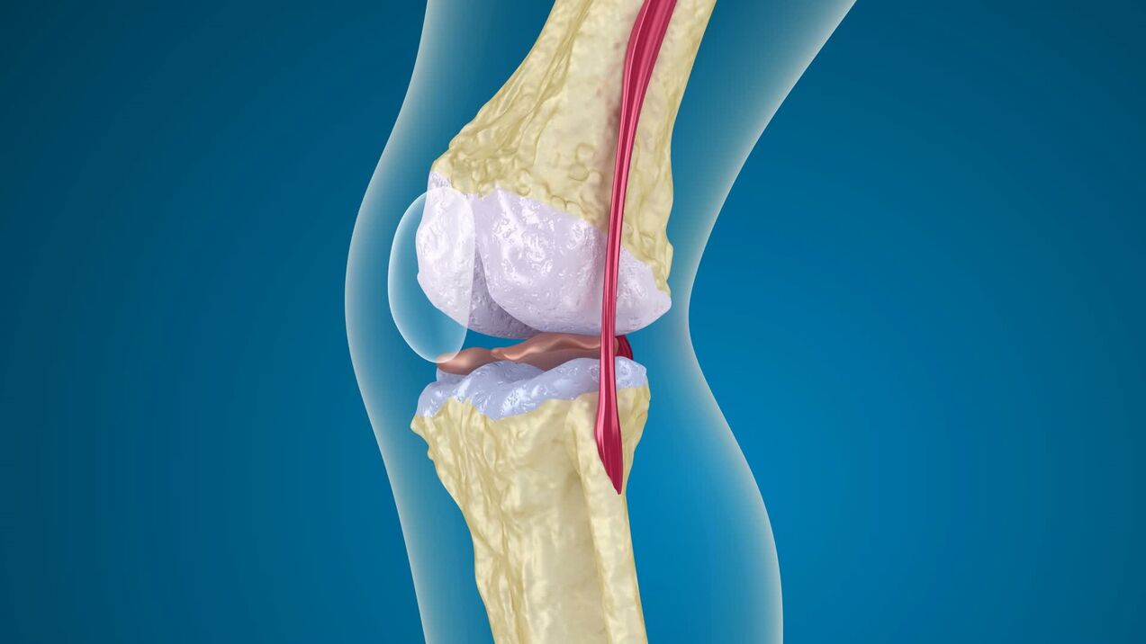 destruction of the knee joint with osteoarthritis