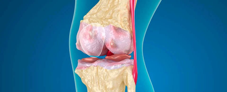 knee osteoarthritis as a cause of pain