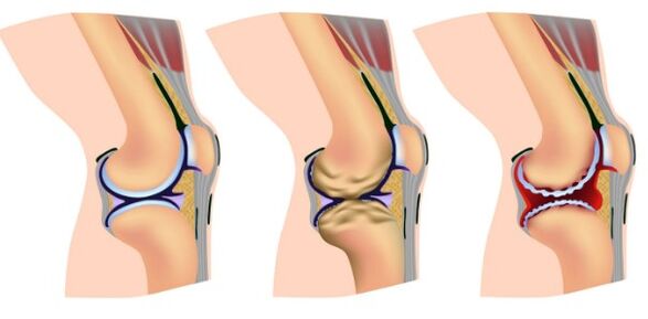 Knee joint deformation steps