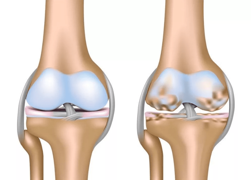 Osteoarthritis