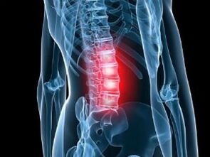 Osteochondrosis of the lumbar column