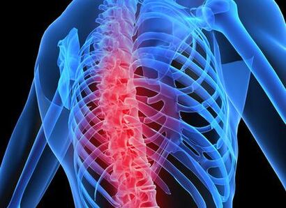 osteochondrosis of the thoracic spine