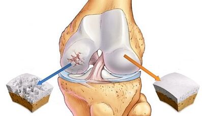The reasons for the development of articulation osteoarthritis