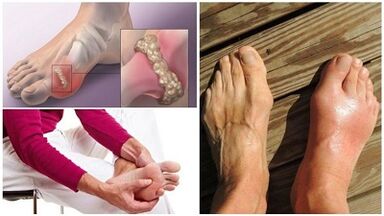 What is articulation arthritis